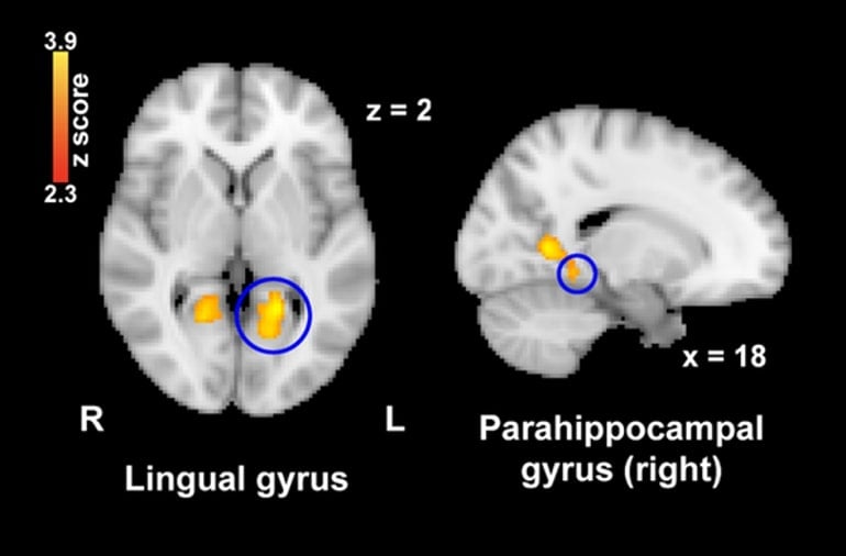 This shows brain scans with the lingual gyrus and parahippocampal gyrus highlighted