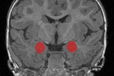 This shows the amygdala highlighted in a brain scan