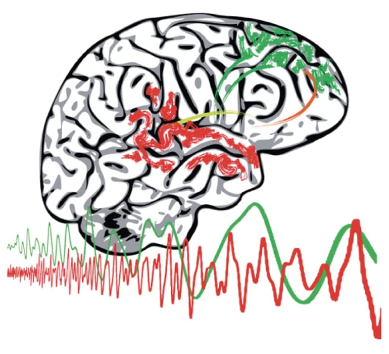 This shows a drawing of a brain with squiggles showing the communication deficits