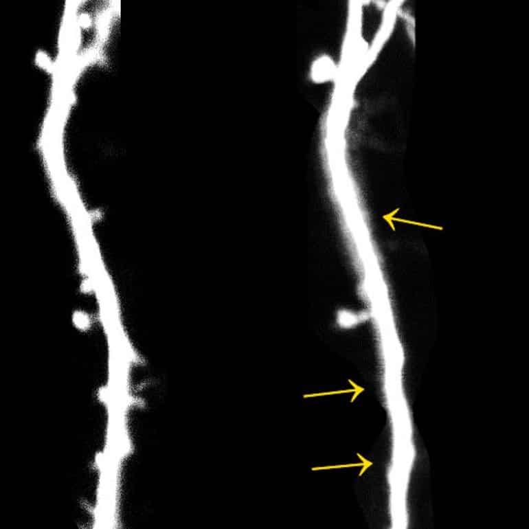 This shows the synapses labeled with arrows on a neuron