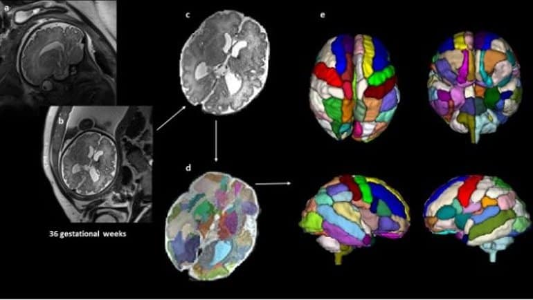 This shows perinatal brain scans with the ASD related areas highlighted