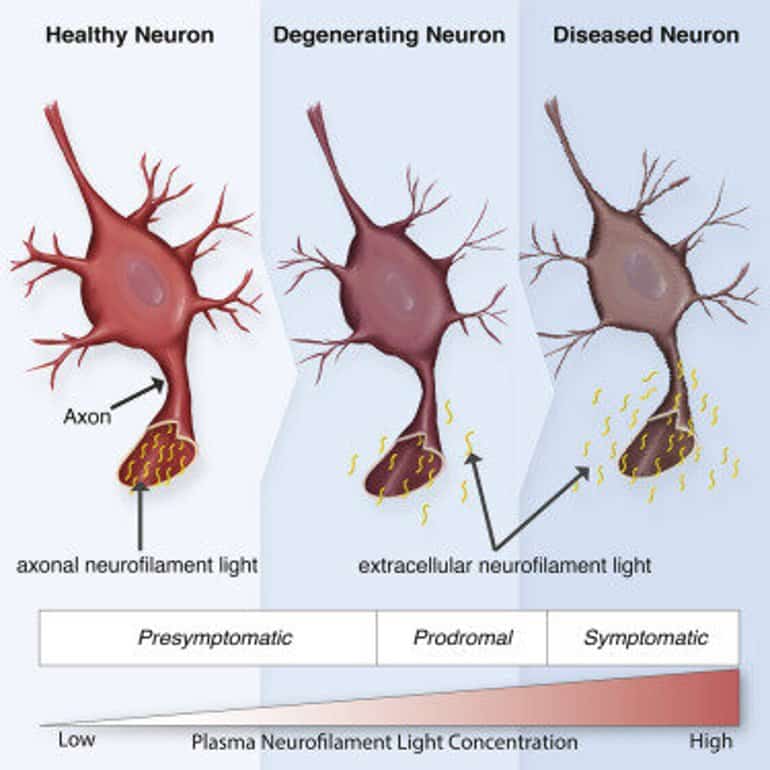 This shows different drawings of neurons from healthy to diseased