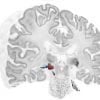 This shows the metathalamic structures in the brain