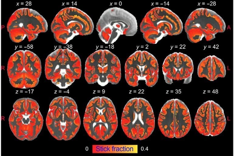 This shows brain scans from the study