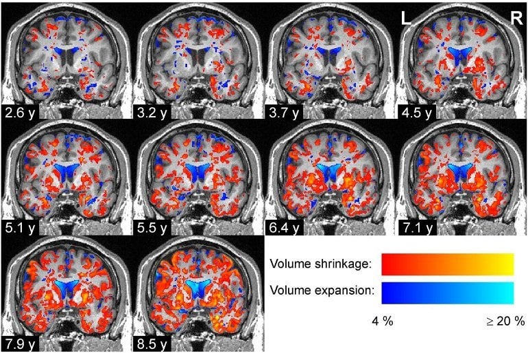 This shows brain scans from the study