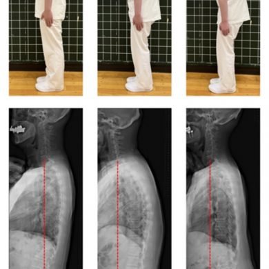 This shows a man in three different posture poses and x rays