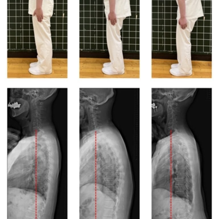 Posture Assessed in Health Exam Detects Cognitive Decline