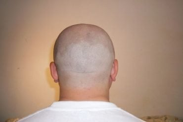 This shows a bald man's head