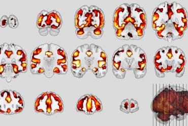 This shows brain scans of a schizophrenia patient