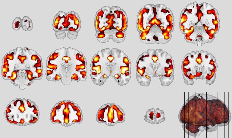 Similarity Between Schizophrenia and Dementia Discovered for the First Time - Neuroscience News