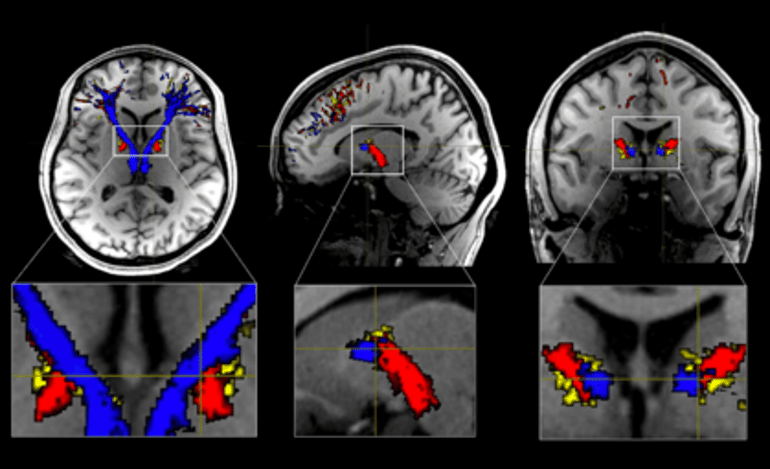 This shows brain scans from the study