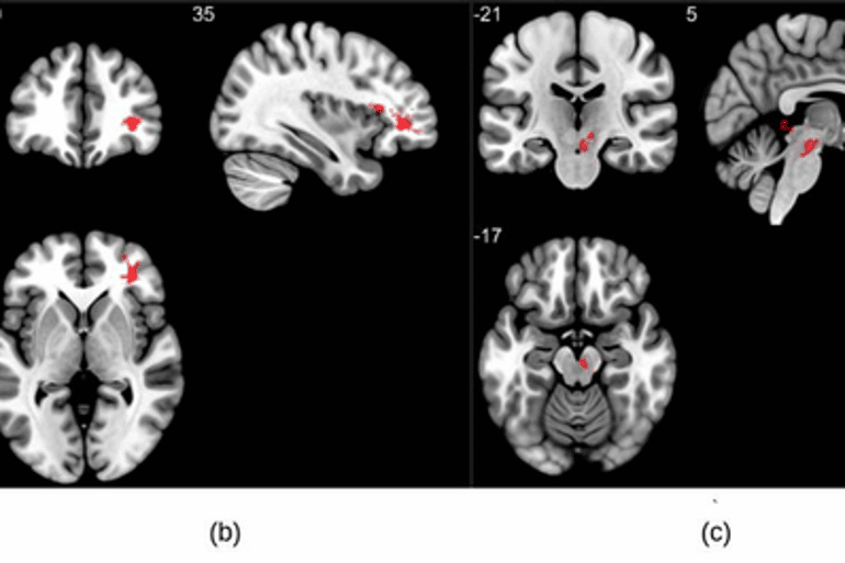 MRI Reveals Significant Brain Abnormalities Post-COVID – Neuroscience News