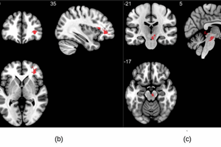 This shows brain scans from the study