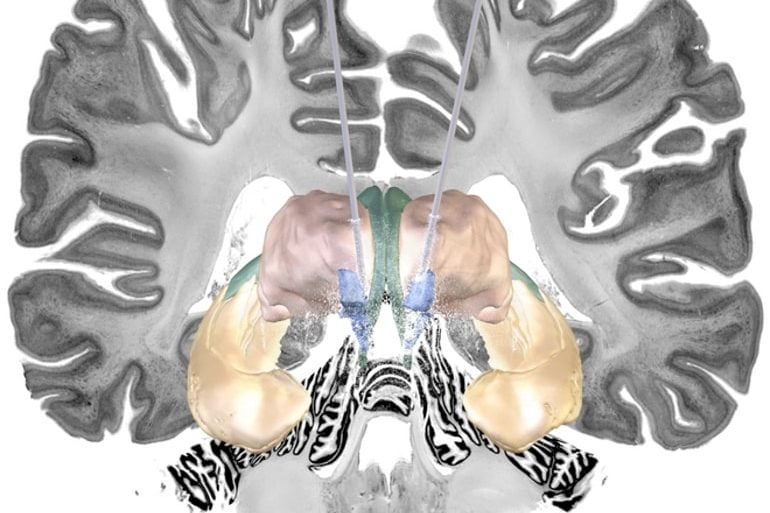 This shows a brain slice with areas highlighted