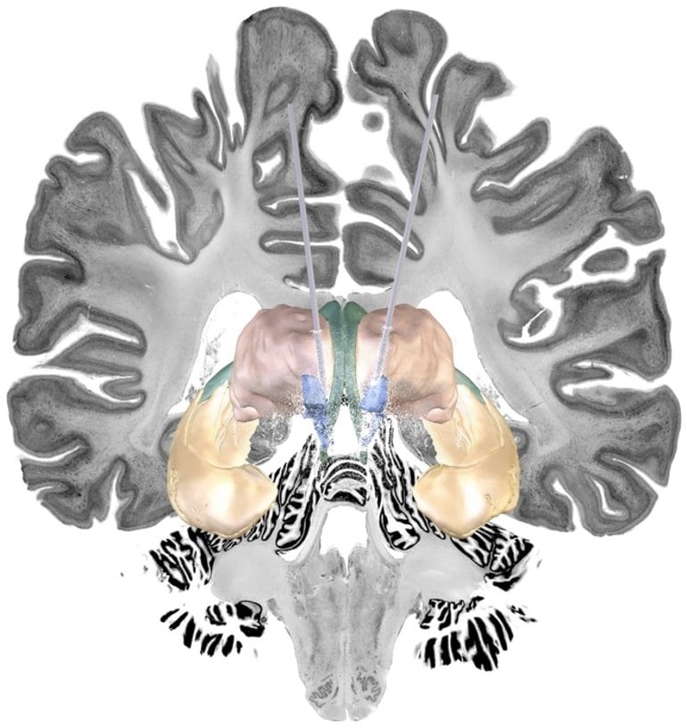 This shows a brain slice with areas highlighted