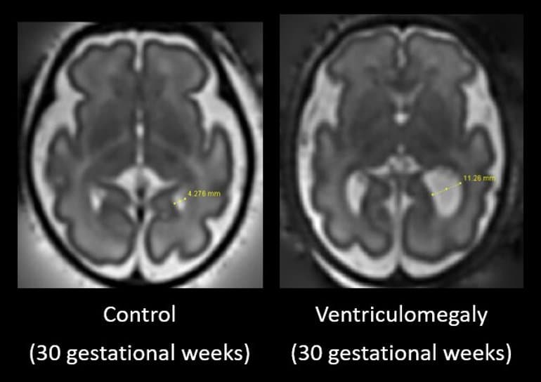 Časné známky autismu lze identifikovat při skenování mozku plodu