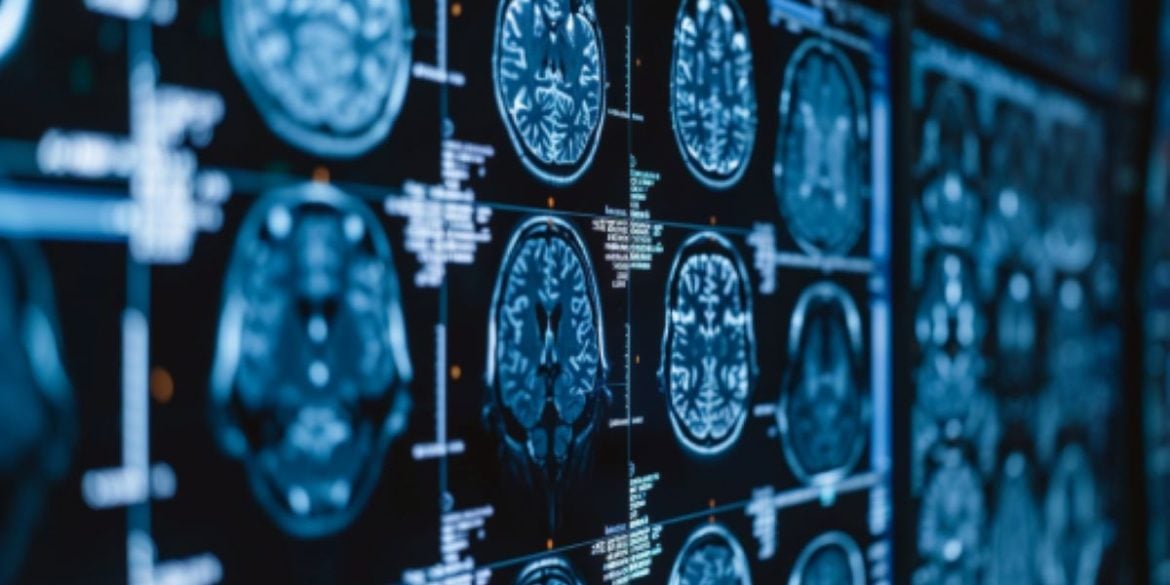 AI Tool Speeds Up Brain Tumor Classification