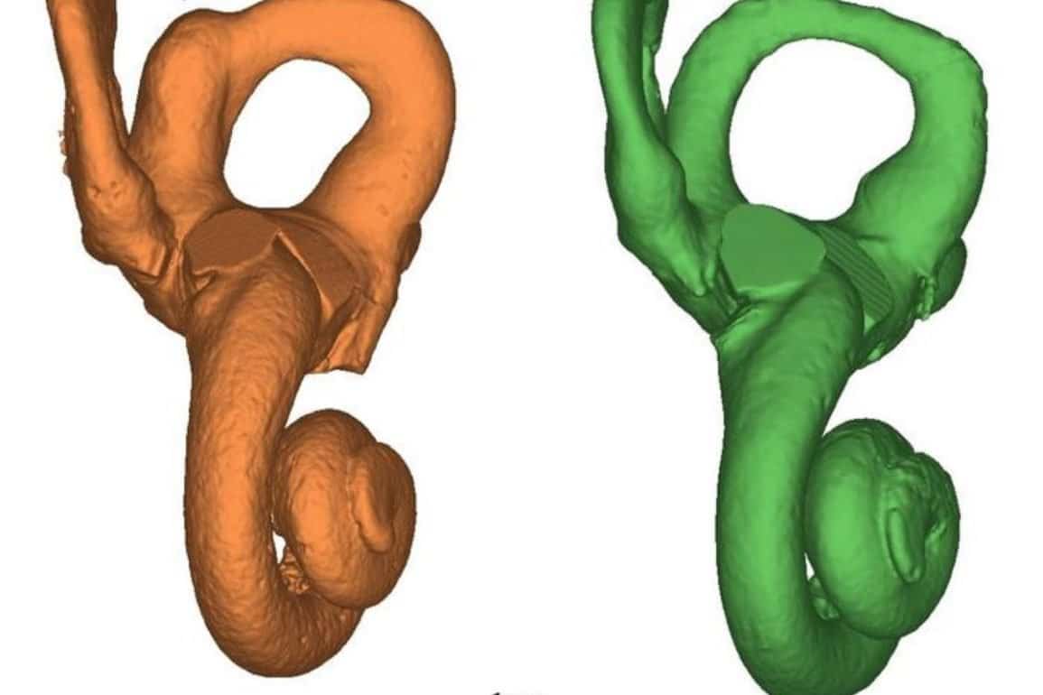 First Neandertal with Down Syndrome: Evidence of Altruistic Care in Prehistory