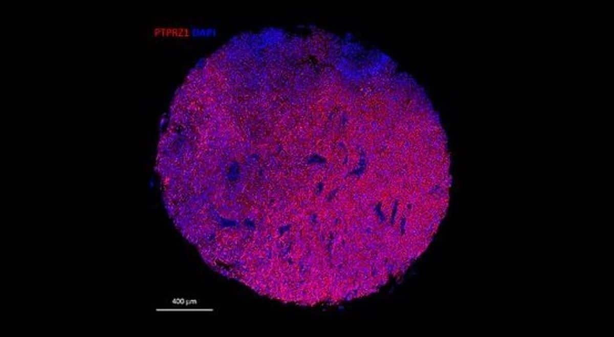 Novel CAR-T Remedy Displays Promise in Concentrated on Glioblastoma – Neuroscience Information