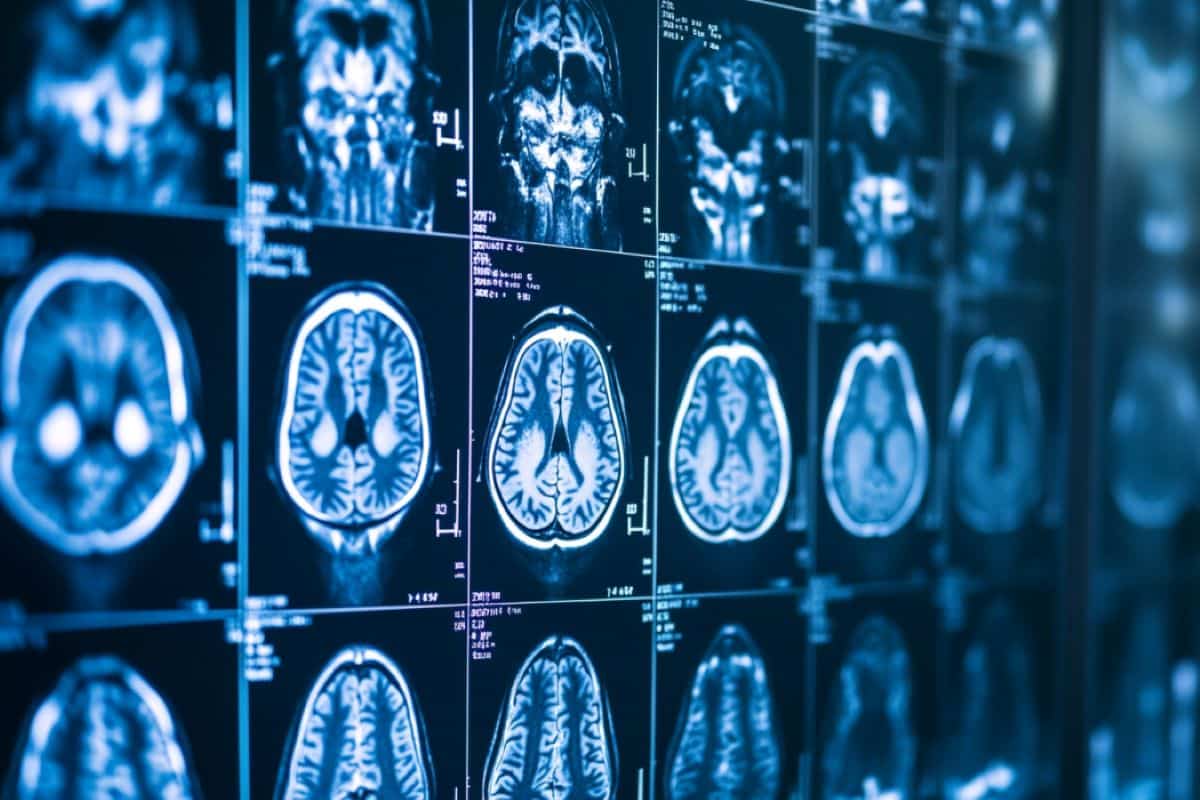 L’IRM améliorée par l’IA montre un potentiel pour détecter des anomalies cérébrales