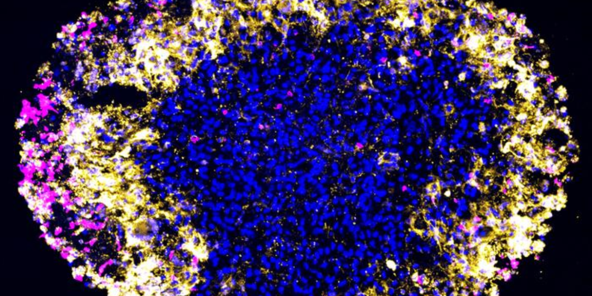 This shows the glioblastoma model.