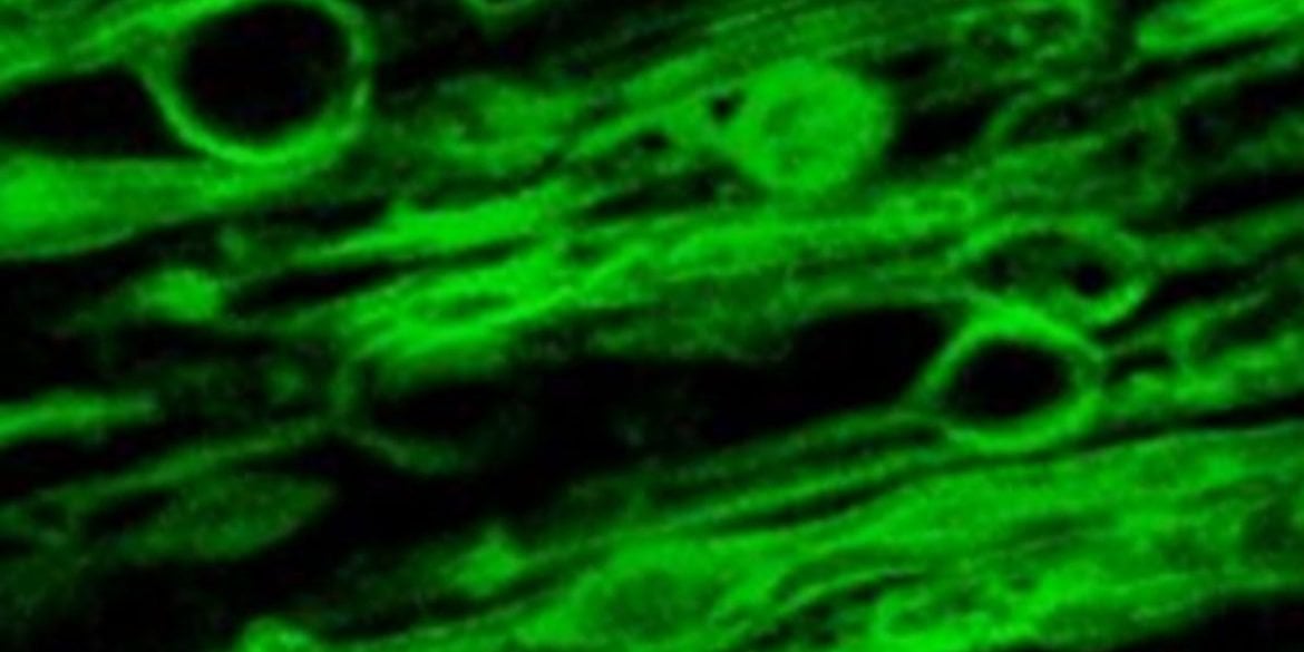 This shows a microscopy image of myelin swelling in a brain sample.