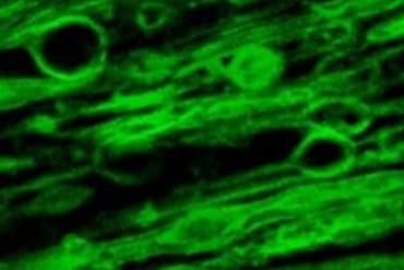 This shows a microscopy image of myelin swelling in a brain sample.