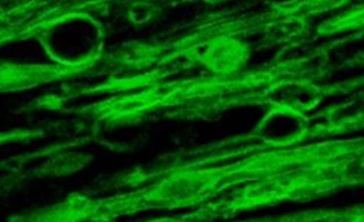 This shows a microscopy image of myelin swelling in a brain sample.