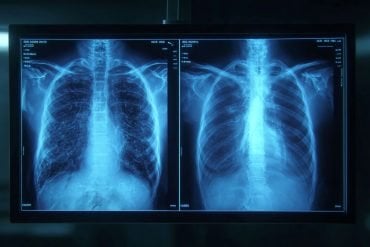 This shows two x rays of a chest.