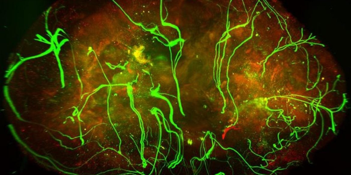 Nerves (in green) within a melanoma tumor.