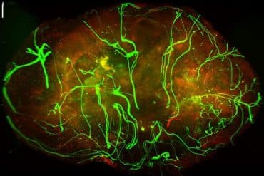 Nerves (in green) within a melanoma tumor.