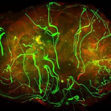 Nerves (in green) within a melanoma tumor.