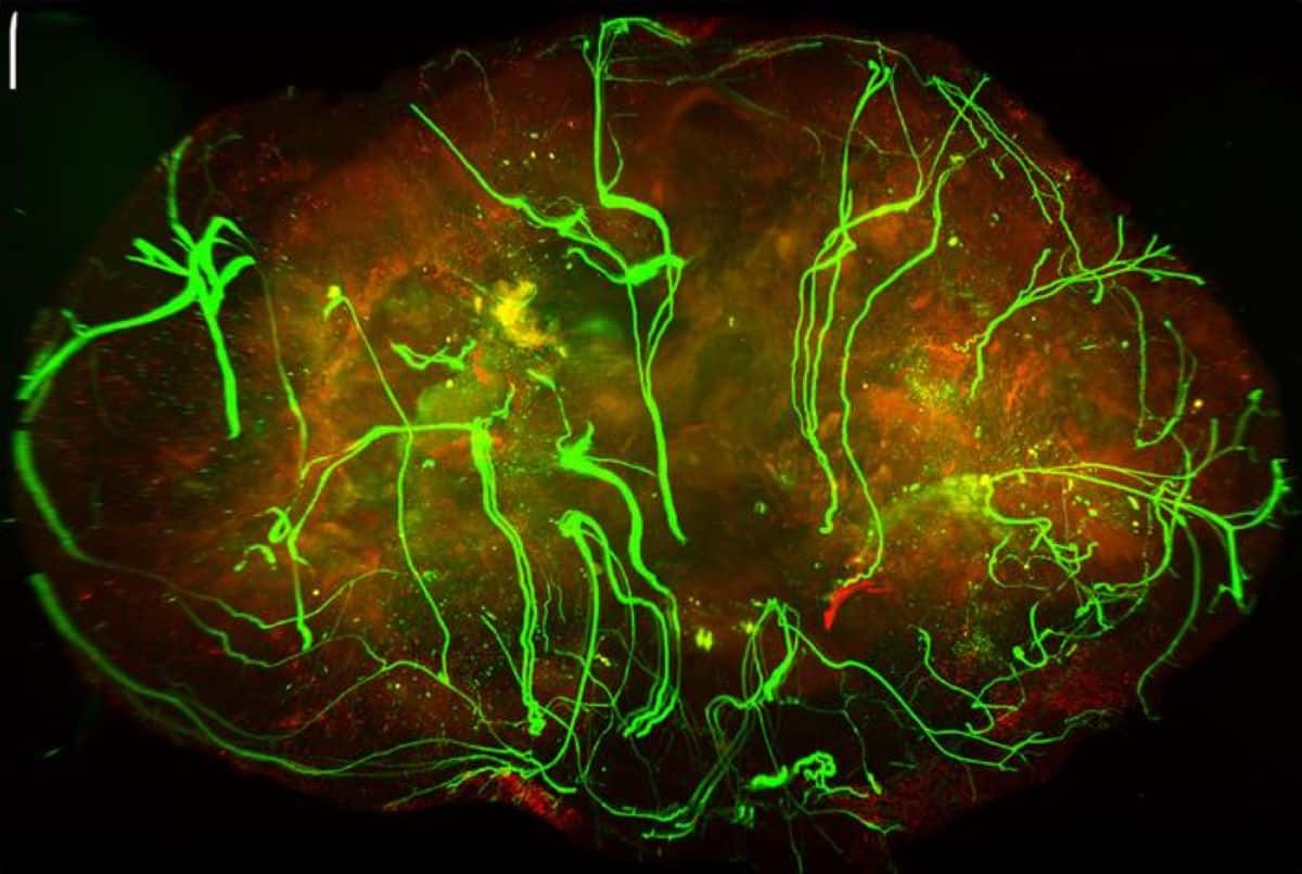 Nerves (in green) within a melanoma tumor.