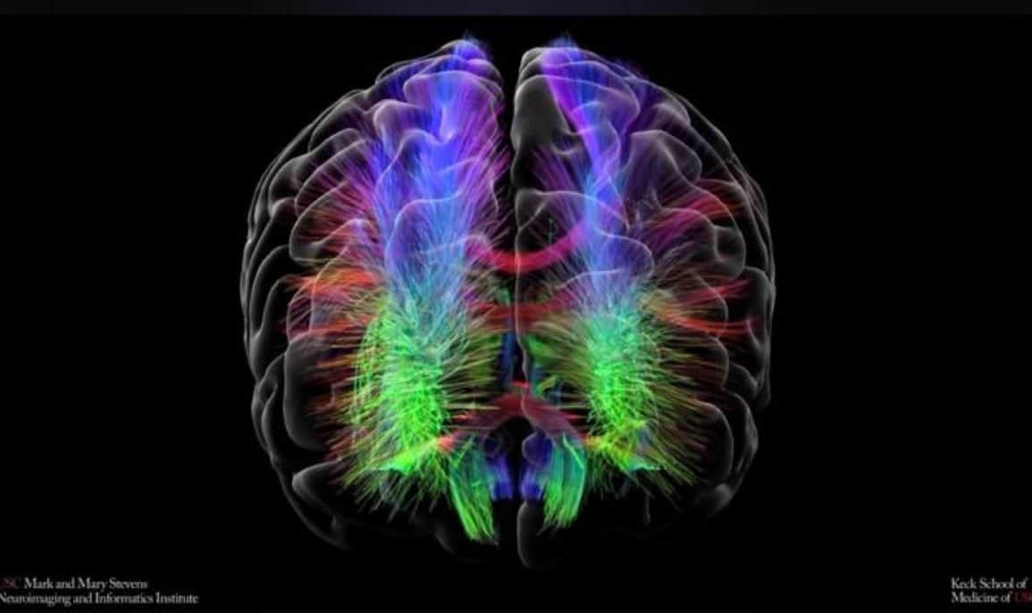 Bipolar Disorder Linked to Less Efficient Brain Wiring Networks