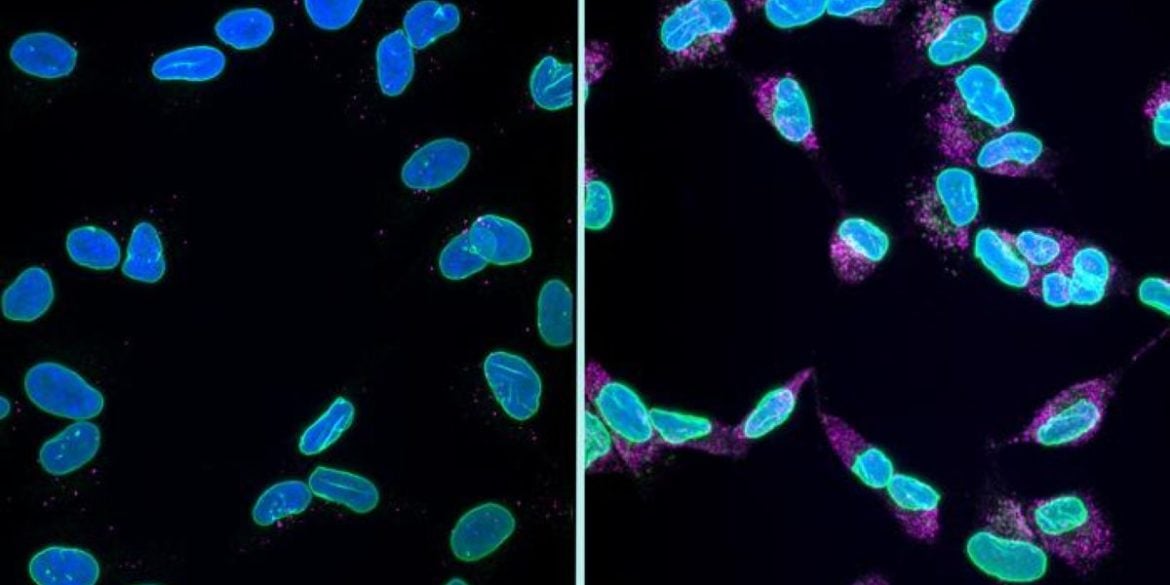 This shows cells undergoing karyoptosis.