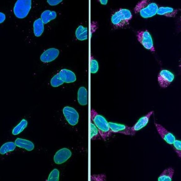 This shows cells undergoing karyoptosis.