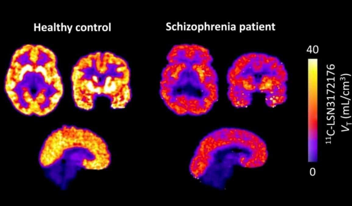 Widespread M1 Receptor Deficits in Schizophrenia Found