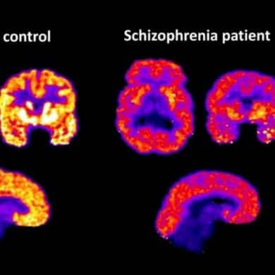This shows brain scans from the study.