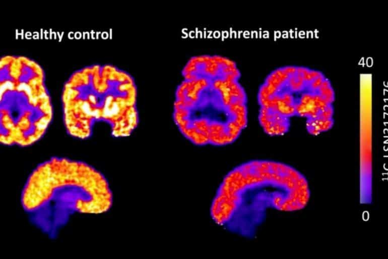 This shows brain scans from the study.