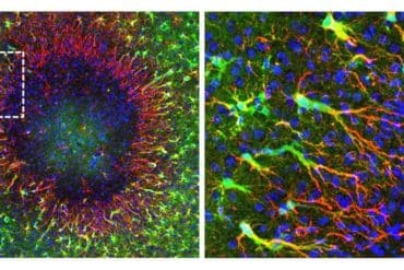 This shows the astrocytes repairing damaged tissue in the brain.