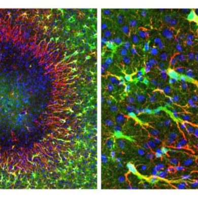 This shows the astrocytes repairing damaged tissue in the brain.