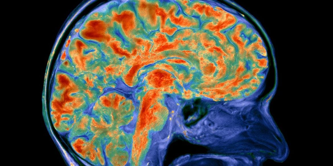 This shows a PET scan.