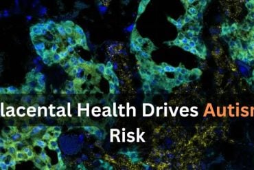 This shows placental cells. Caption reads "Placental health drives autism risk."