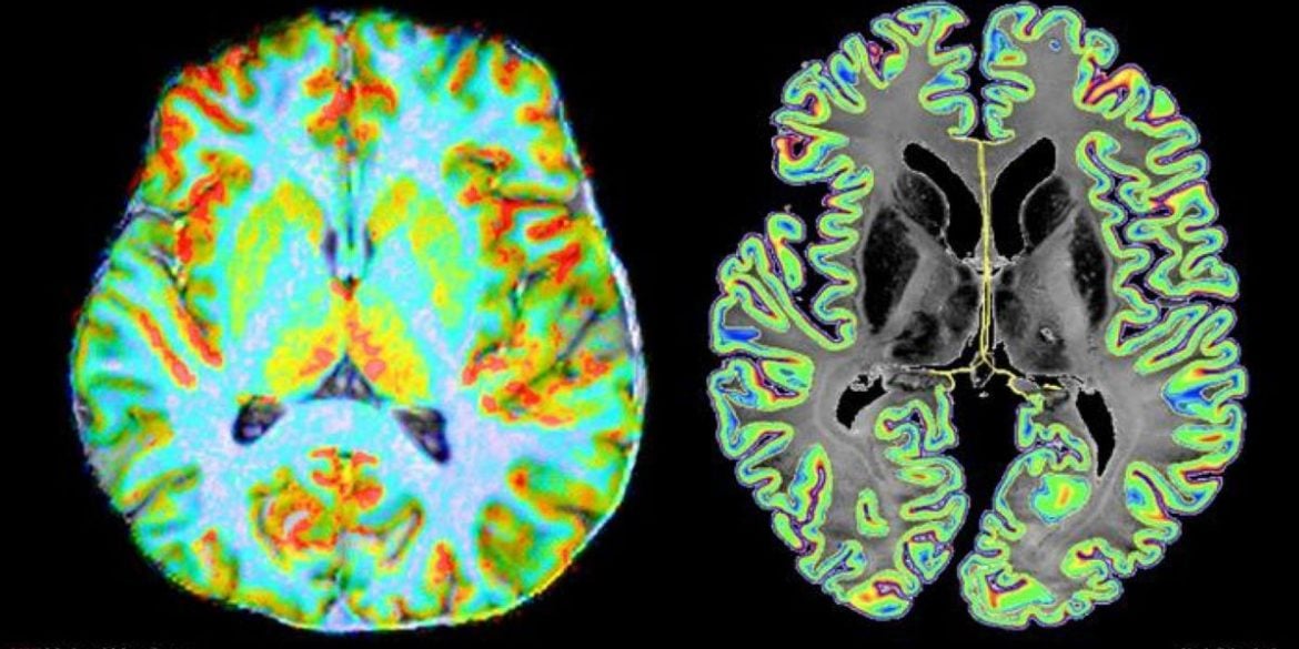 This shows the brain scans from the study.