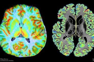 This shows the brain scans from the study.