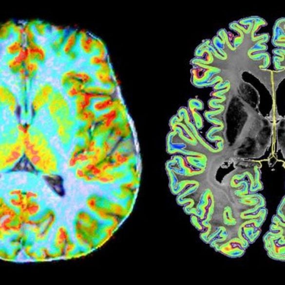 This shows the brain scans from the study.