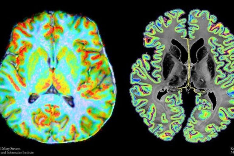 This shows the brain scans from the study.