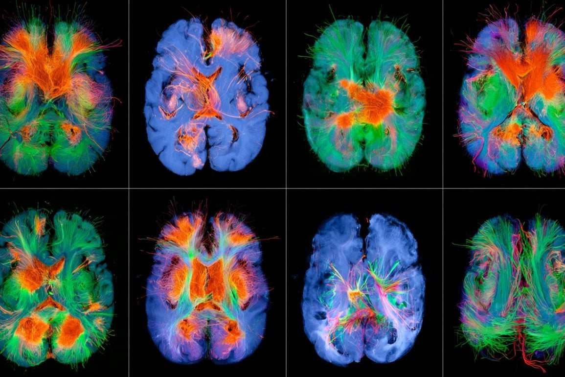 Early DBS Protects Cognition in Genetic Parkinsons