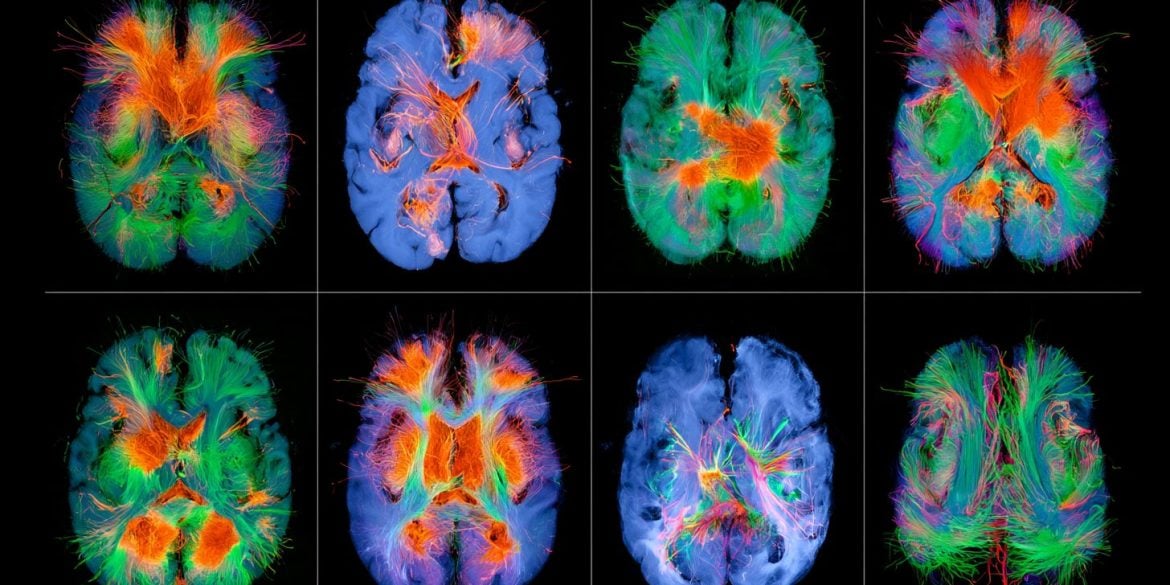This shows brain scans.