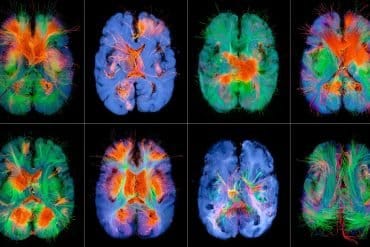 This shows brain scans.